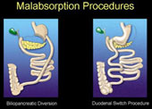 Short Lectures about Laparoscopic Morbid Obesity Surgery
